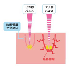 周囲の皮膚へのダメージを最小限に抑えた治療